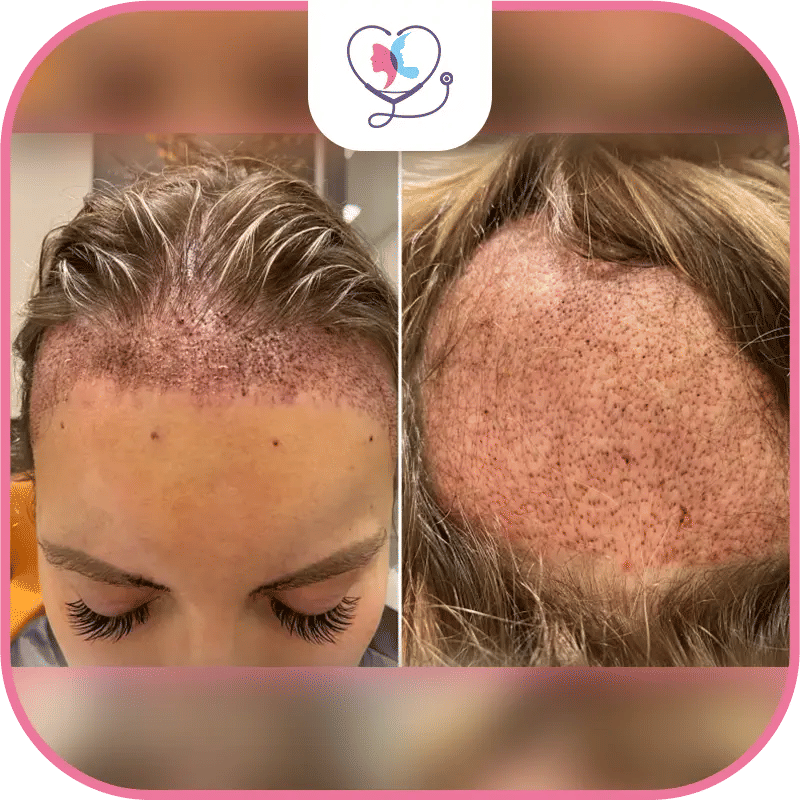 Hair Transplant Techniques for Women