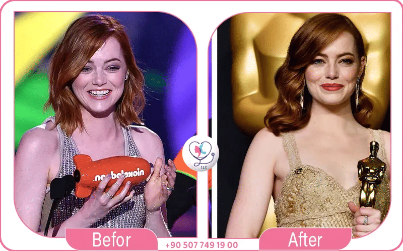 Emma Stone Face Changes