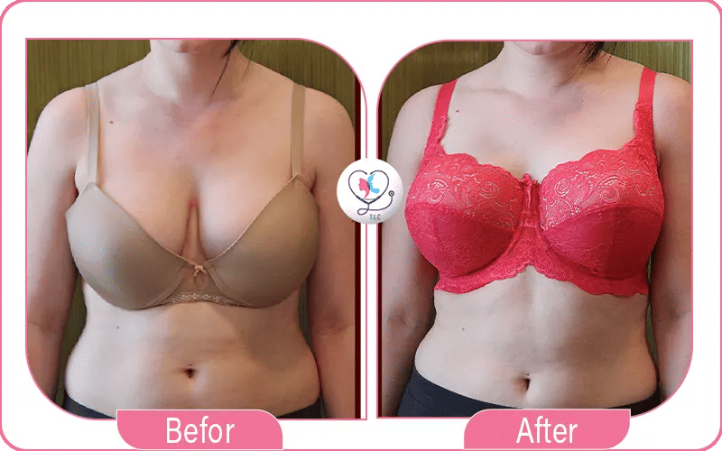 تجارب عملية شد الثدي مع ندى من السعودية