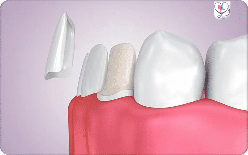 Qu’est-ce que des facettes dentaires ?