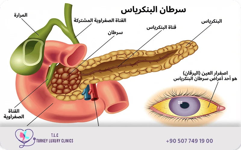 مراحل سرطان البنكرياس