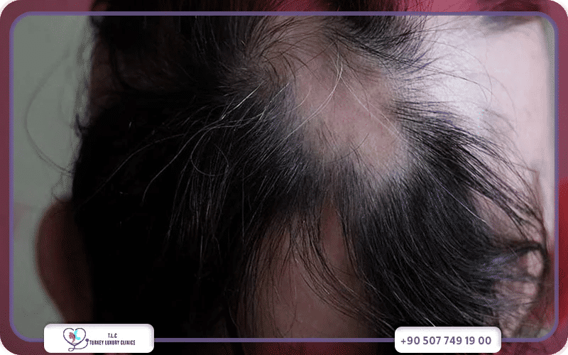 علاج الثعلبة