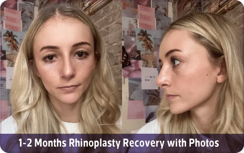 1 2 Months Rhinoplasty Recovery with Photos