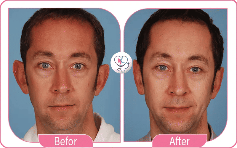 Otoplasty Before and After
