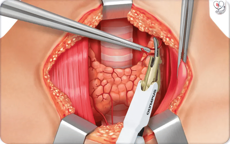 عملية استئصال الغدة الدرقية