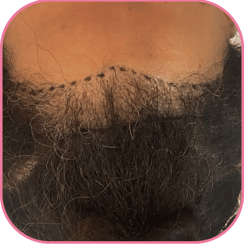 Hair Transplant for Women with Thinning Hair
