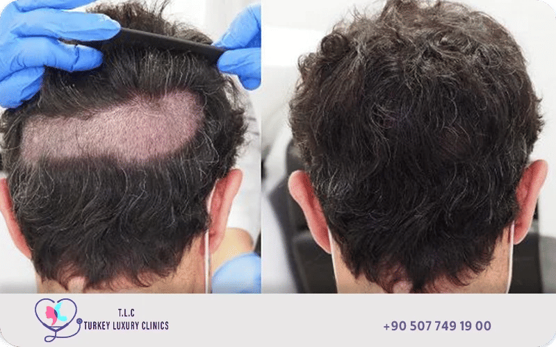 زراعة الشعر بدون حلاقة في تركيا لاكشري كلينك زراعة الشعر بدون حلاقة في تركيا لاكشري كلينك