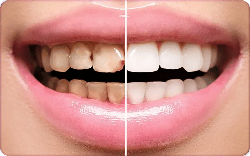 Why Veneers Can't Replace Missing Teeth?