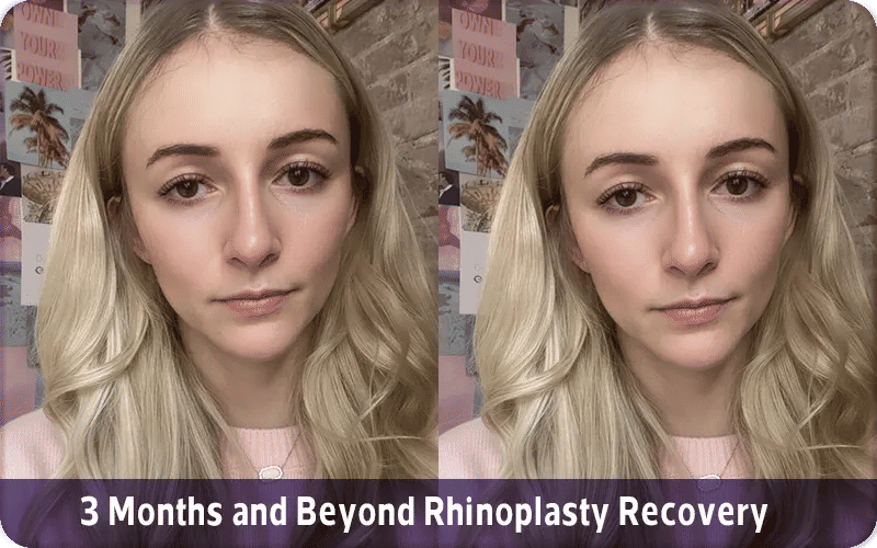 3 Months and Beyond Rhinoplasty Recovery with Photos
