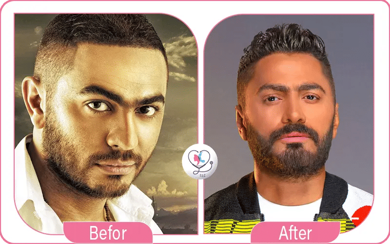 تامر حسني قبل وبعد عمليات التجميل