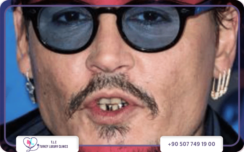Johnny Depp smile makeover cost comparison Turkey vs USA – affordable veneers and dental crowns at Turkey Luxury Clinics