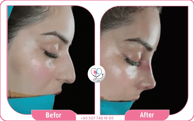 لماذا تختار افضل دكتور تجميل انف في تركيا؟