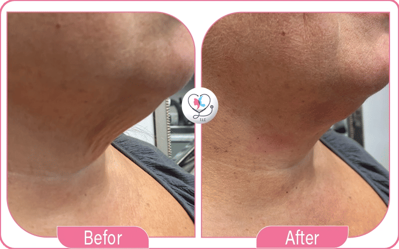 صور شد اللغلوغ بالخيوط قبل وبعد 2