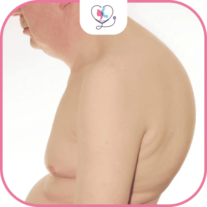 ما هي تكلفة جراحة الحداب في تركيا؟