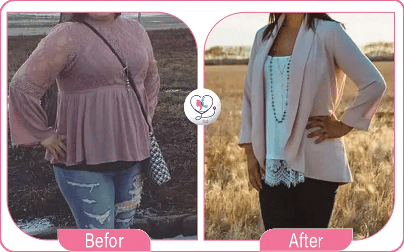 كيف تعمل تجربتي مع بوتكس المعدة؟