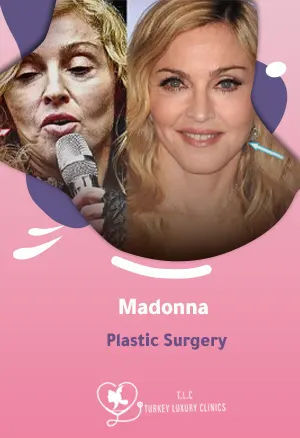 Madonna Schönheitschirurgie: Gerüchte, Vorher-Nachher & 2025featured image