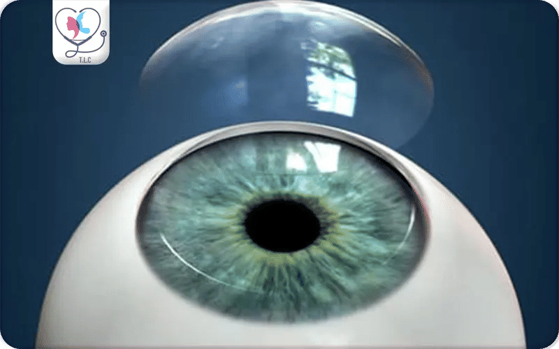 How Many Times Can You Have a Corneal Transplant?