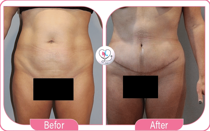 What Happens to the Belly Button During Tummy Tuck Surgery?