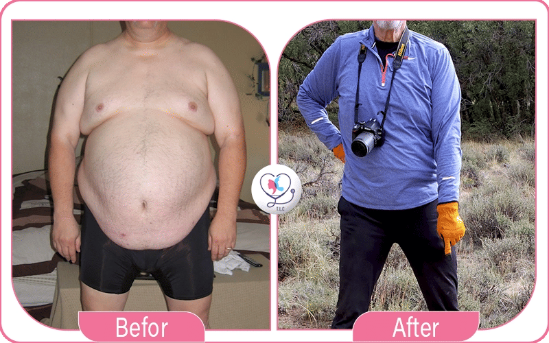 عملية تصحيح تكميم المعدة | أنواع تصحيح التكميم -1772048968869