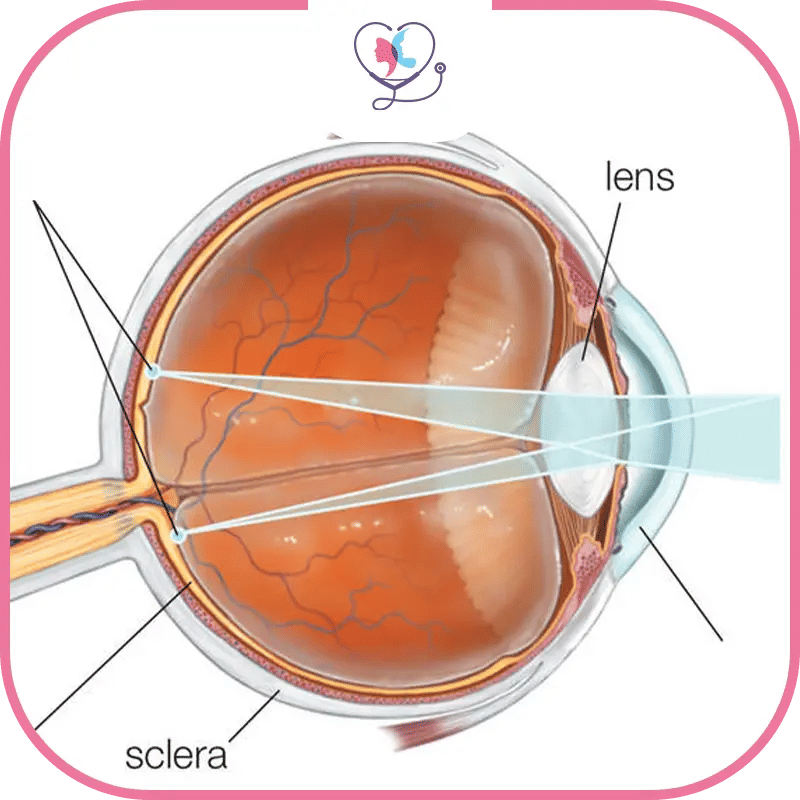 انحراف النظر