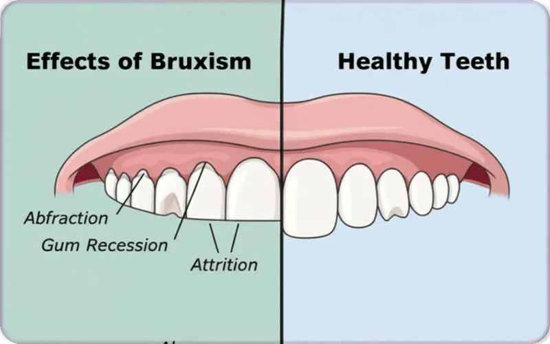 How Does Teeth Grinding Affect Natural Teeth?