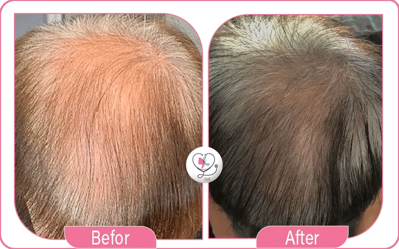 المرشحون تجربة علاج الخلايا الجذعية للشعر المرشحون تجربة علاج الخلايا الجذعية للشعر