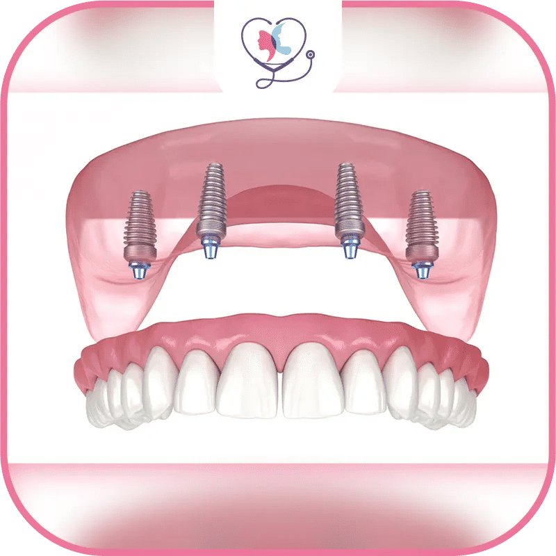 rehabilitation complete sur implants dentaires