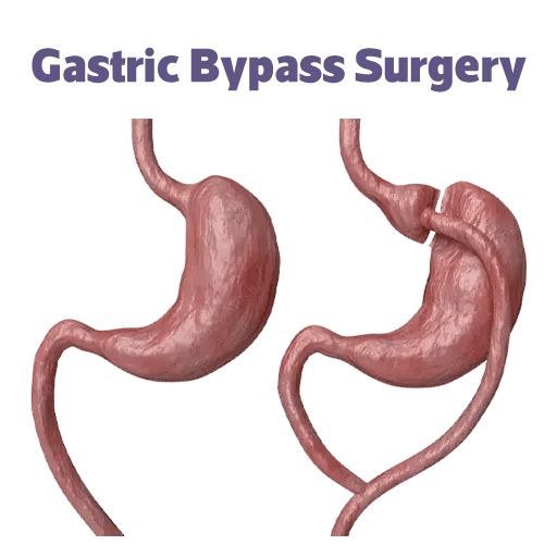 ماهي عملية تحويل مسار المعدة في تركيا؟
