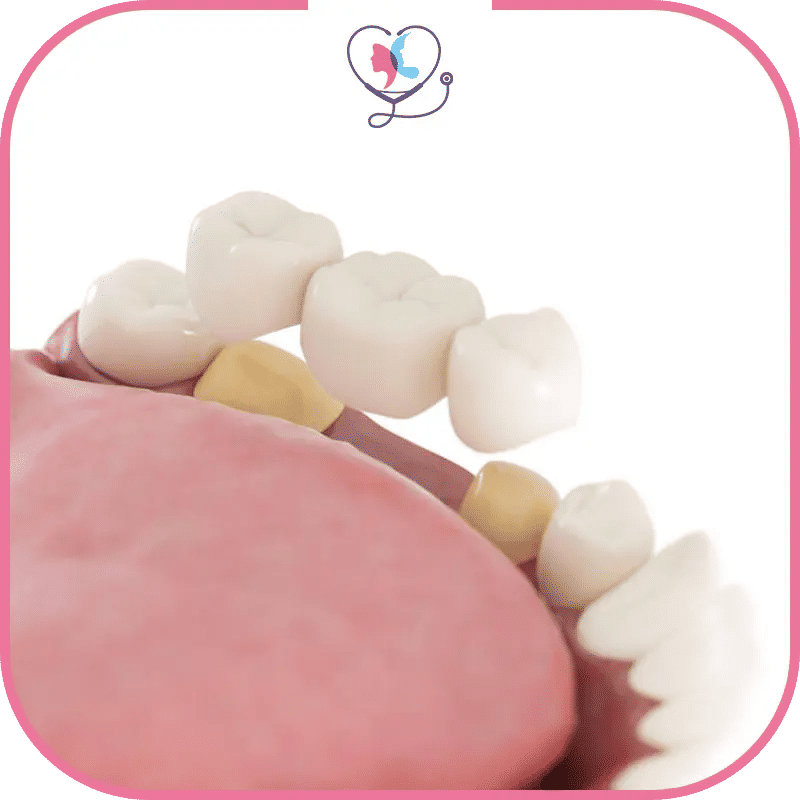 أولاً: جسور الأسنان