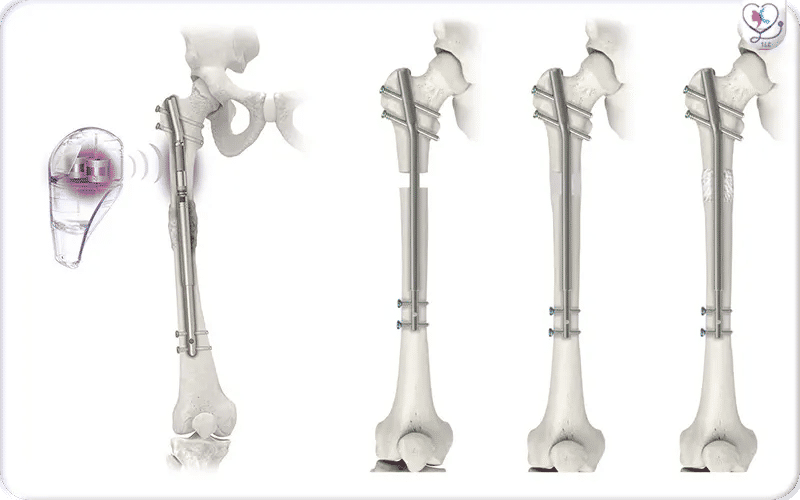How Does Precice MAX Limb Lengthening Work?