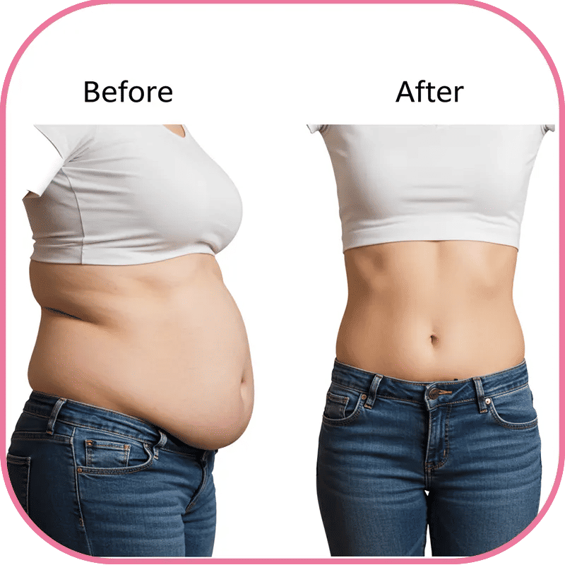 Gastric Sleeve Revision to Bypass Before and After 2