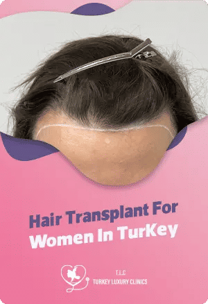 Hair Transplant For Women In Turkey
