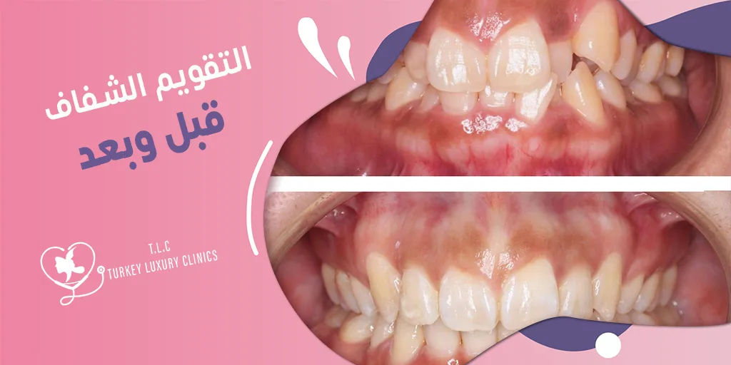 التقويم الشفاف قبل وبعد: صور حقيقية لنتائج مذهلة