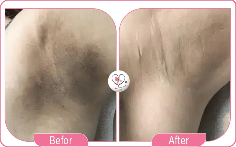 أضرار تفتيح المناطق الحساسة بالليزر وطرق الوقاية