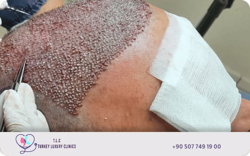 Hair transplant procedure close-up showing follicle extraction for permanent hair restoration results