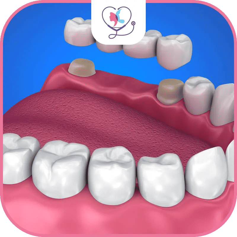 ما هي جسور الأسنان؟