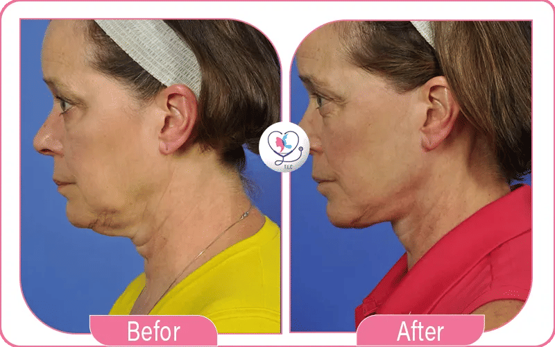 What is a Mini Neck Lift?