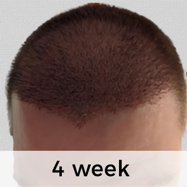 Hair Transplant Week by Week: From Week 1 to Week 48 