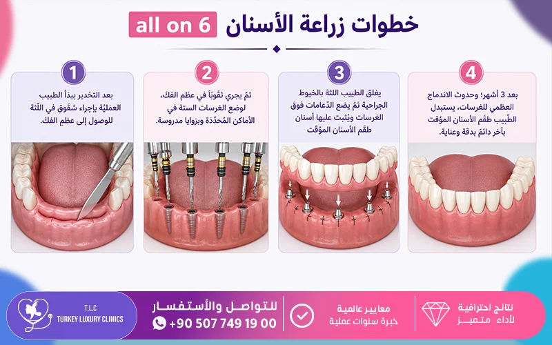 خطوات زراعة الأسنان all on 6