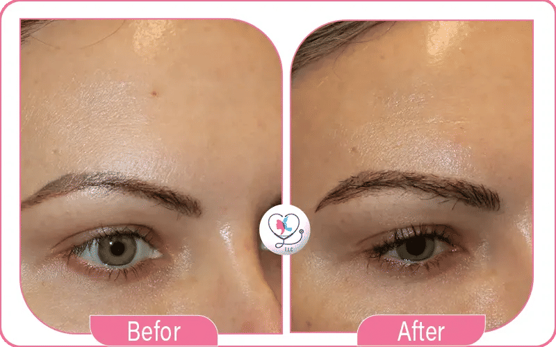 Factors Affecting Eyebrow Transplant Recovery