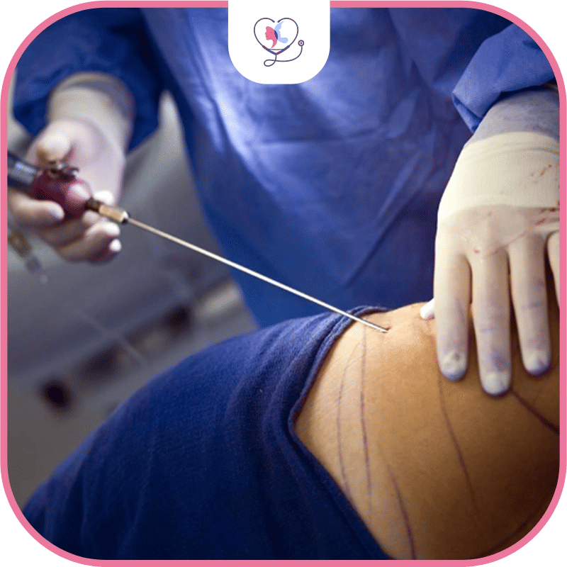 شفط الدهون بالفيزر في تركيا