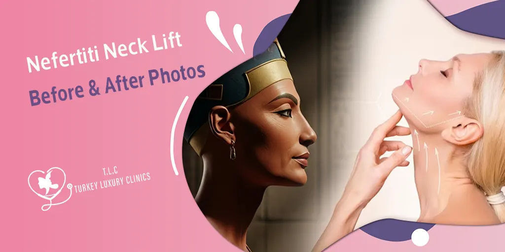 Nefertiti Neck Lift Vorher & Nachher: Ergebnisse