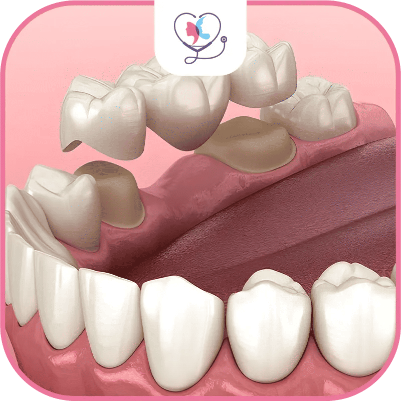 soins du bridge dentaire