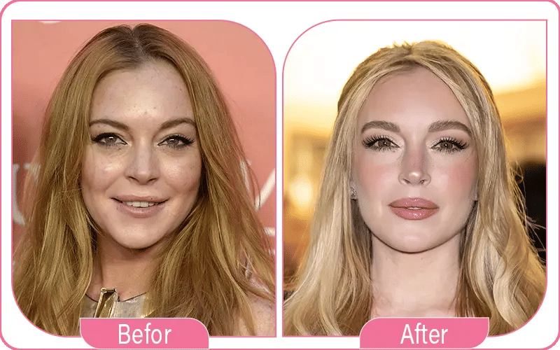 Lindsay Lohan Addresses Facelift Rumors in 2025