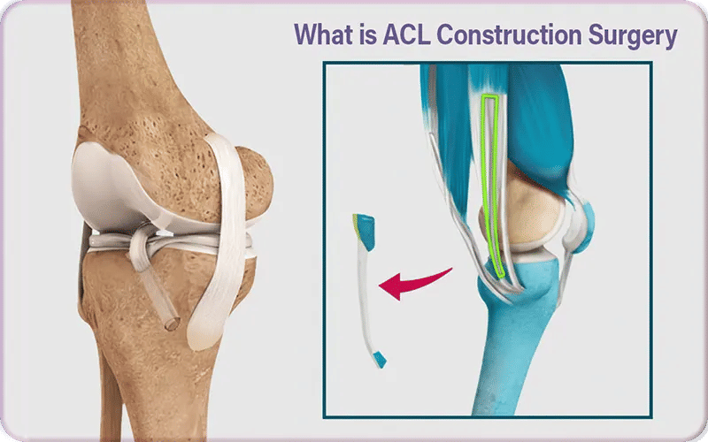 What is ACL Construction Surgery?