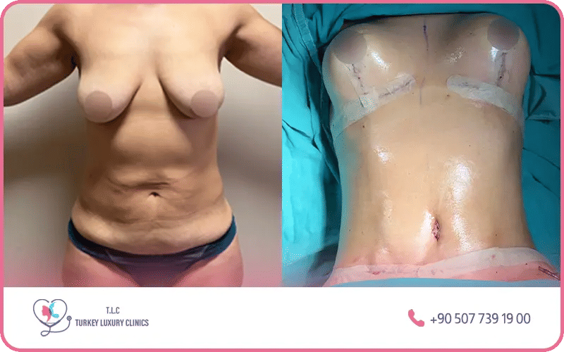  faire remonter les seins (mastopexie)