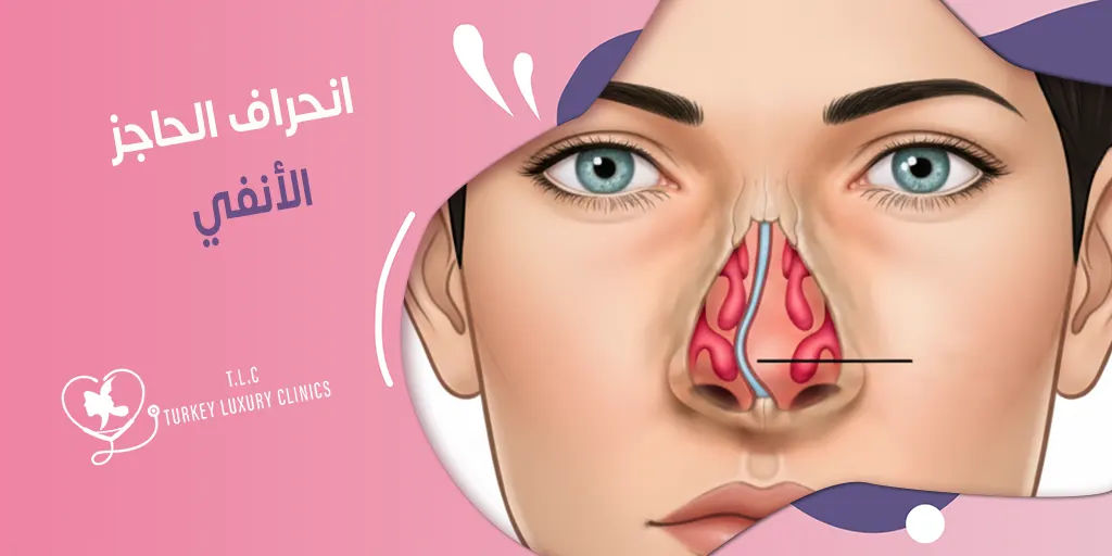 انحراف الحاجز الأنفي: الأعراض والعلاج الجراحي