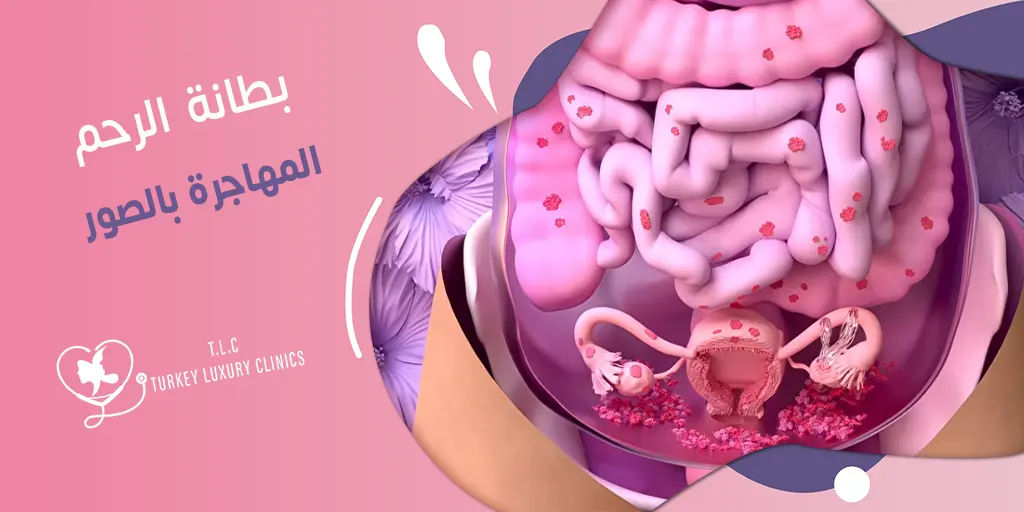 بطانة الرحم المهاجرة بالصور: اللون والشكل والحجم