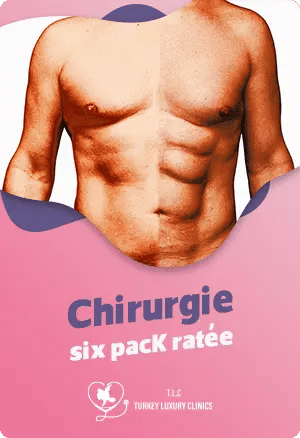 Chirurgie six pack ratée : Causes, symptômes et solutions