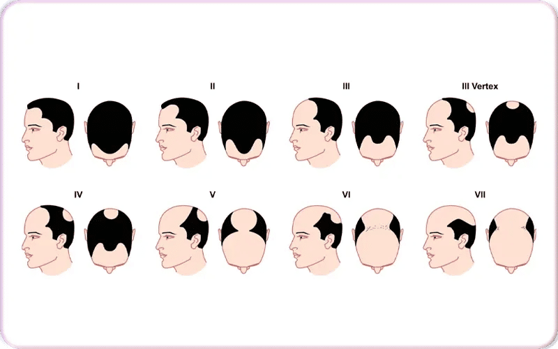 Échelle de Norwood-Hamilton : La référence pour les stades de la calvitie masculine